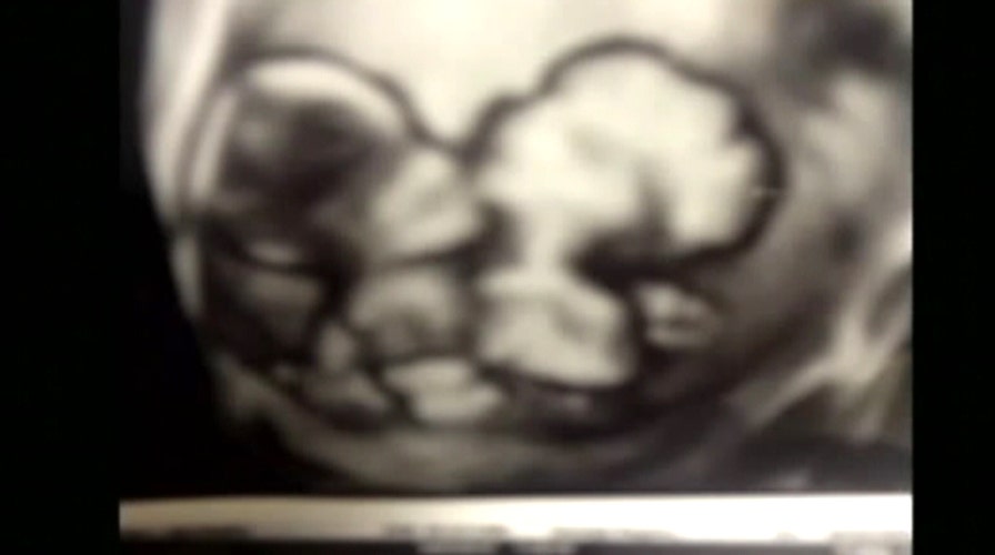 Sonogram reveals conjoined twins 'hugging'