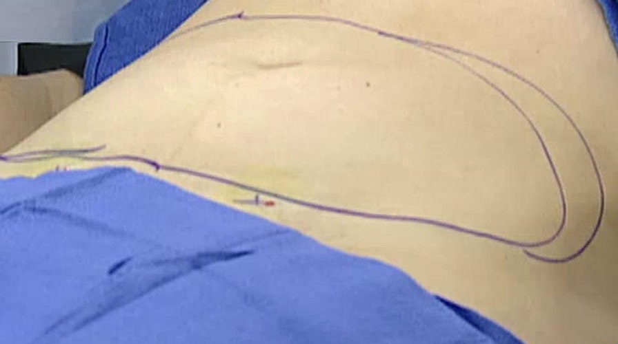 I am thinking about lipo laser treatment: Should I worry? 