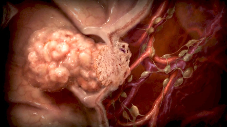 What is Cancer?