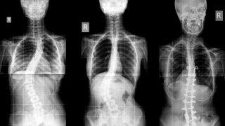 Could you develop adult scoliosis? - Fox News