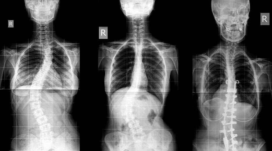 Could you develop adult scoliosis?