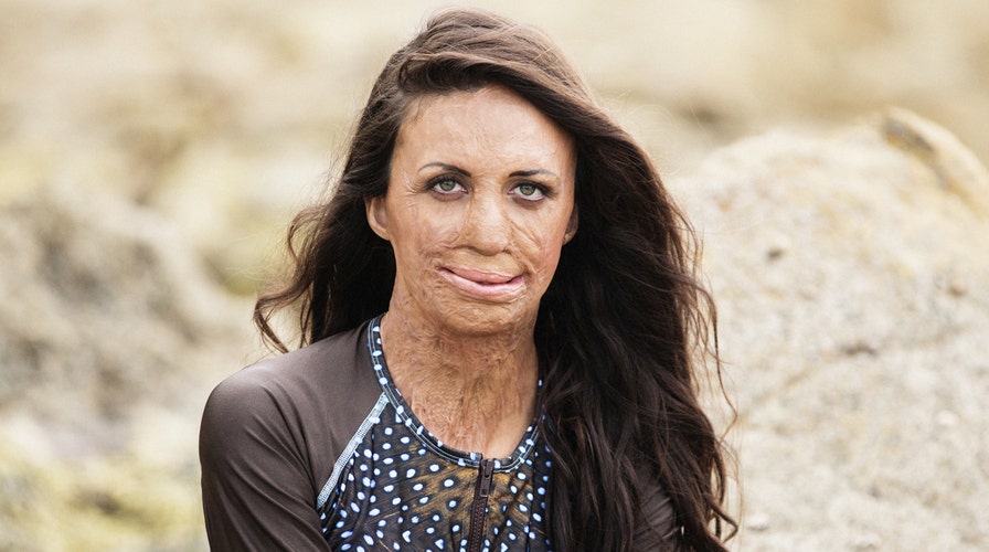 Athlete battles back from severe wildfire burns