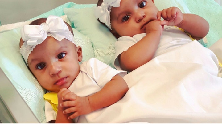 Conjoined twins separated during complex 21-hour procedure