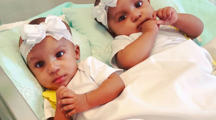 Conjoined twins separated during complex 21-hour procedure