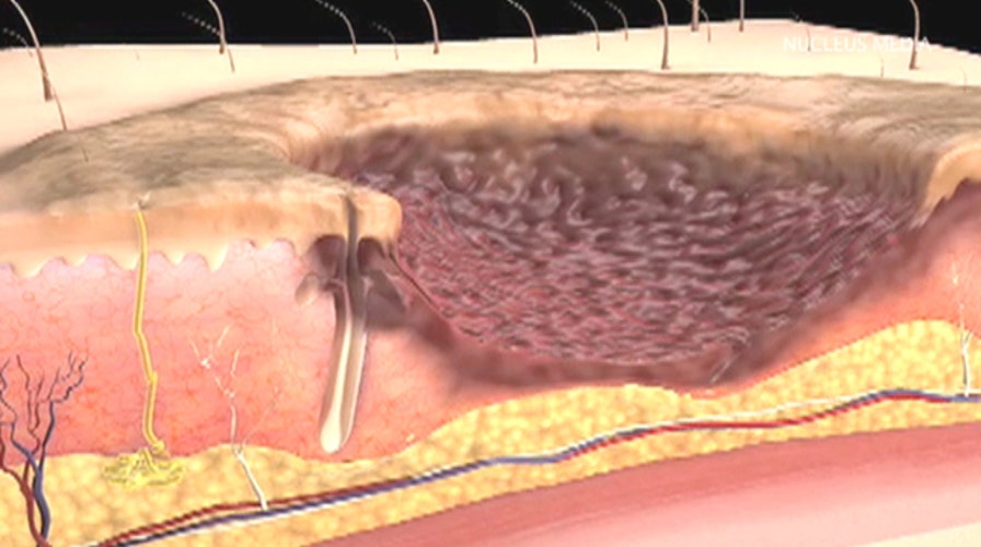 What happens during a skin graft procedure?
