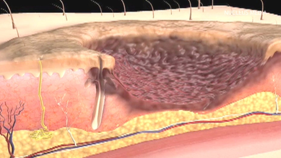 What Happens During A Skin Graft Procedure Fox News