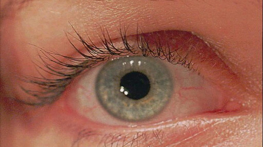 Telescope eye implant helps restore sight