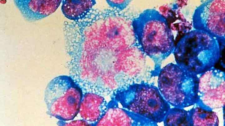 Impact of baby seemingly cured of HIV
