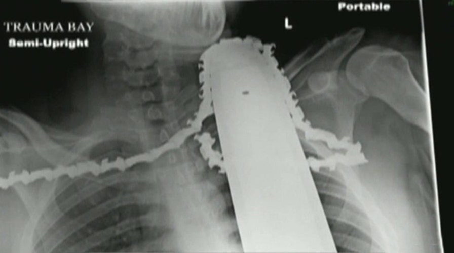 Lucky to be alive: Chainsaw slices into tree cutter's neck