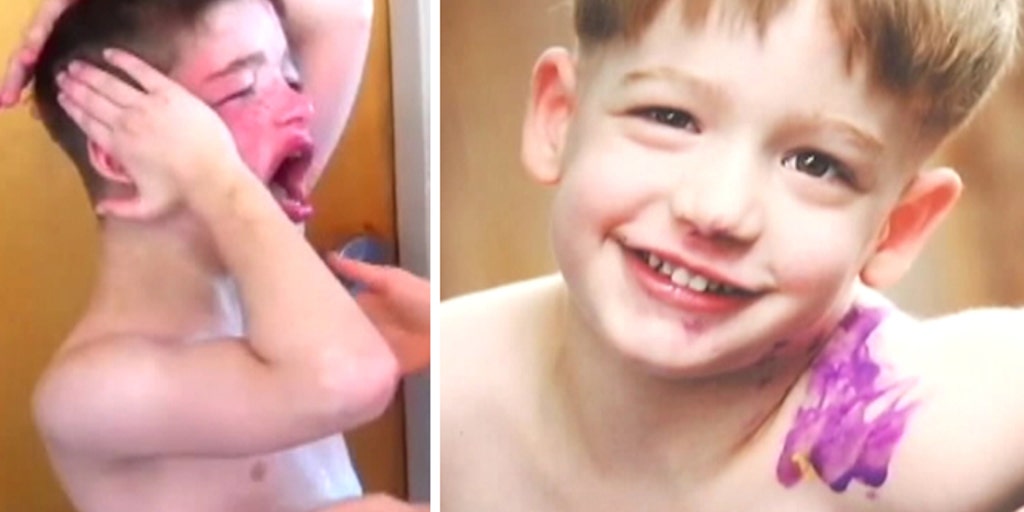 Severely autistic boy uses medical marijuana for treatment | Fox News Video