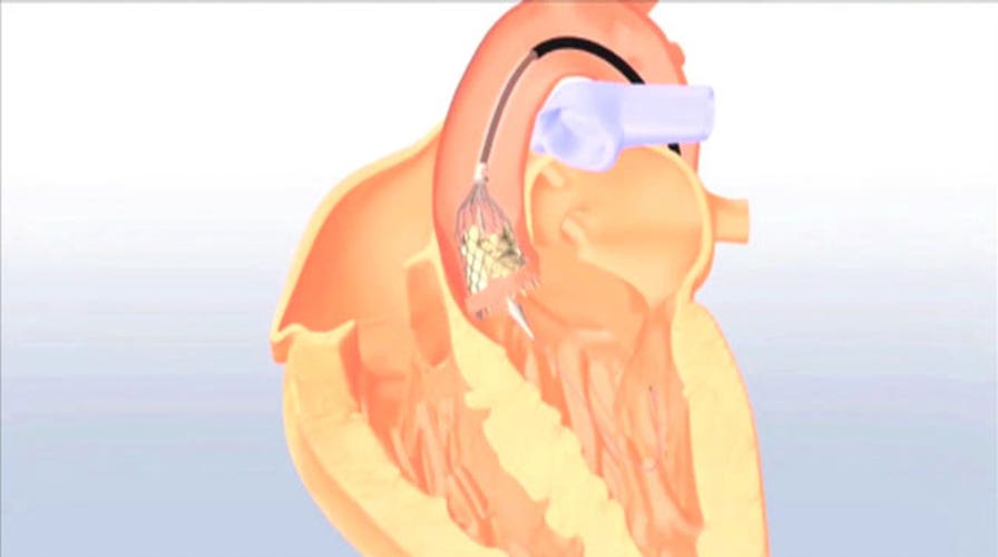 See how surgeons replace a faulty heart valve