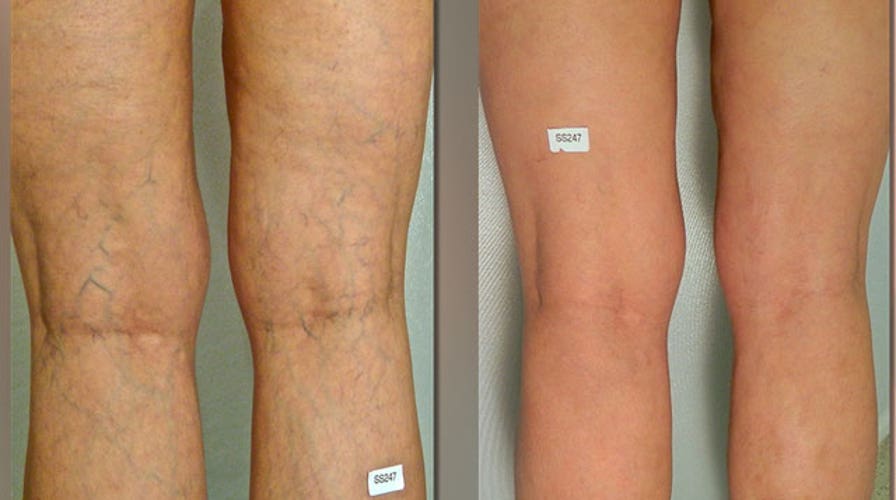 Pain-free solution for spider veins