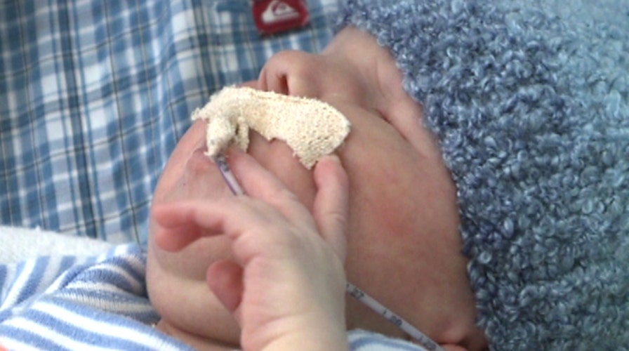 Baby born without eyes