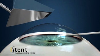 iStent provides permanent relief for glaucoma patients