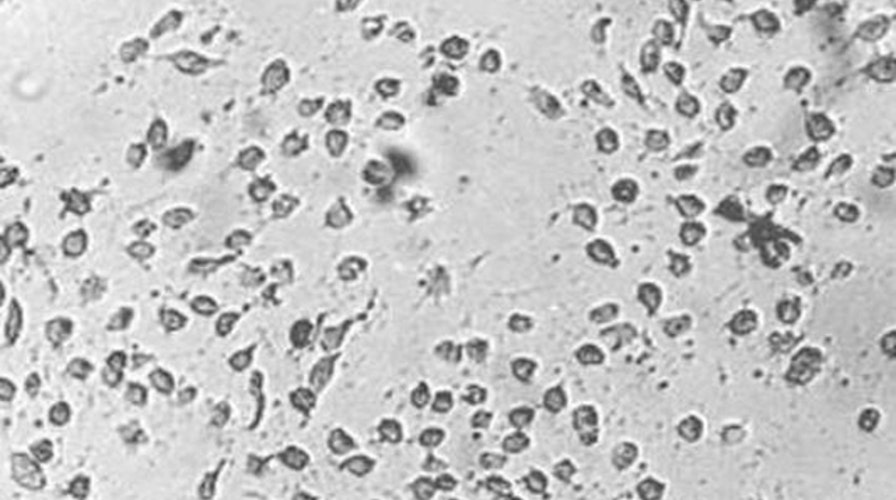 Fewer new cases of enterovirus being reported