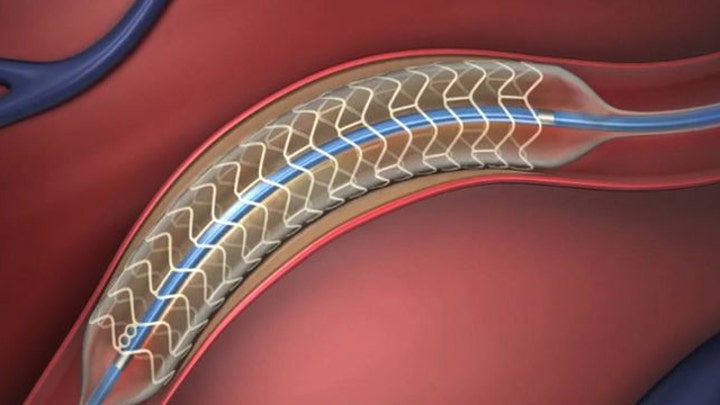 Doctors test stents that dissolve