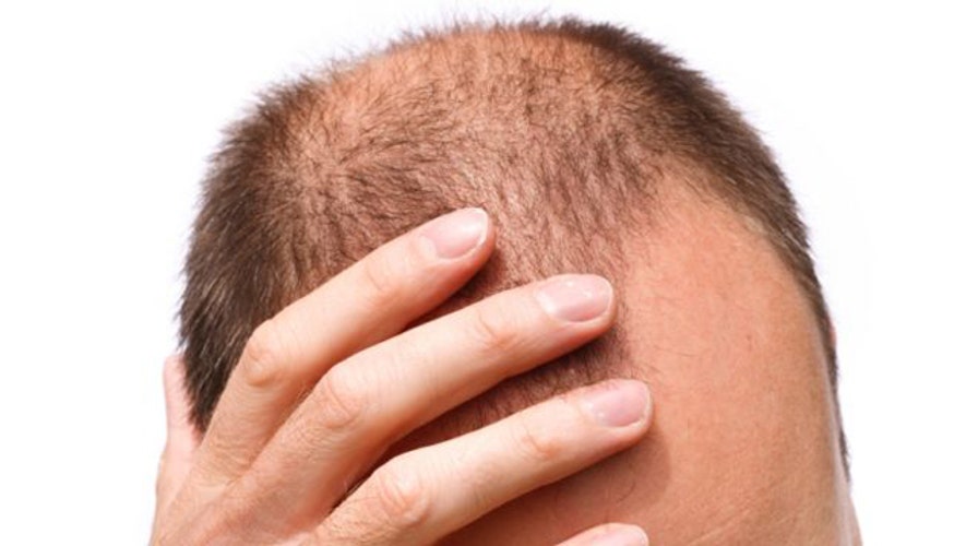 Cure for baldness? Researchers work on potential remedy