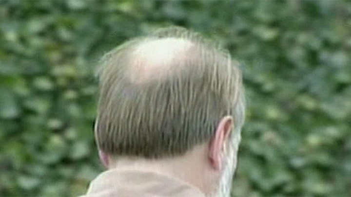 Have researchers found cure for baldness?