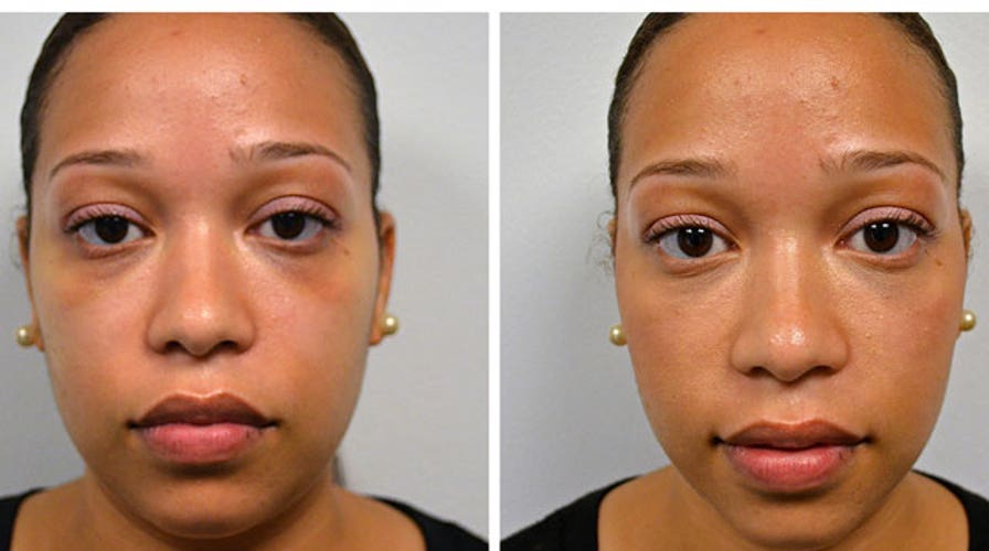 Quick Plastic Surgery for Under Eye Circles