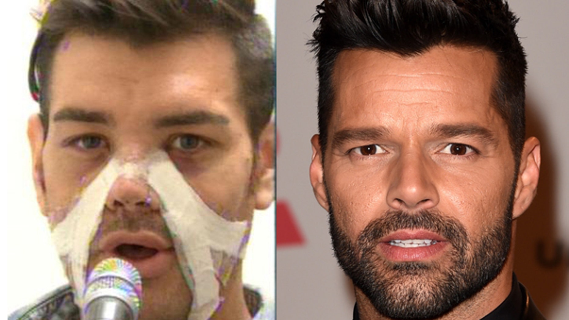 Fran Mariano after his surgery to look like Ricky Martin.