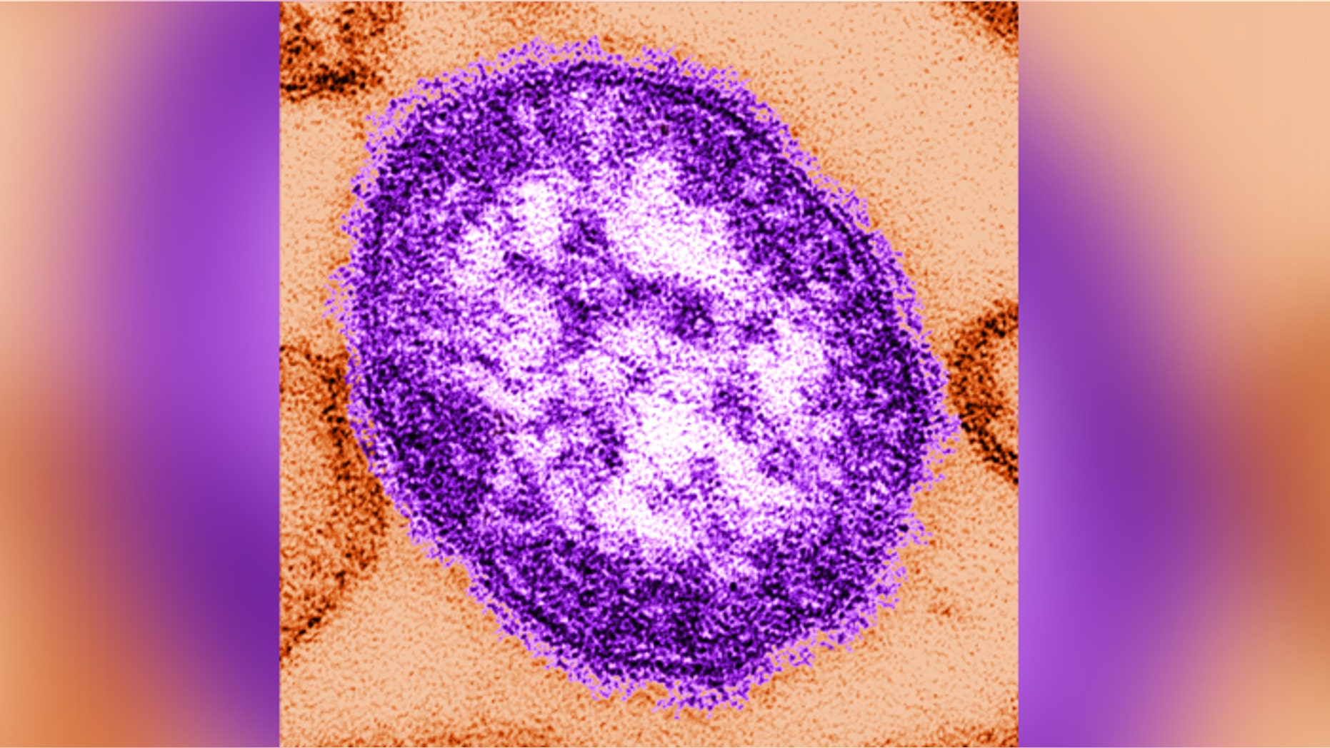 This thin-section transmission electron micrograph (TEM) reveals a single virus particle, or virion, of measles virus.