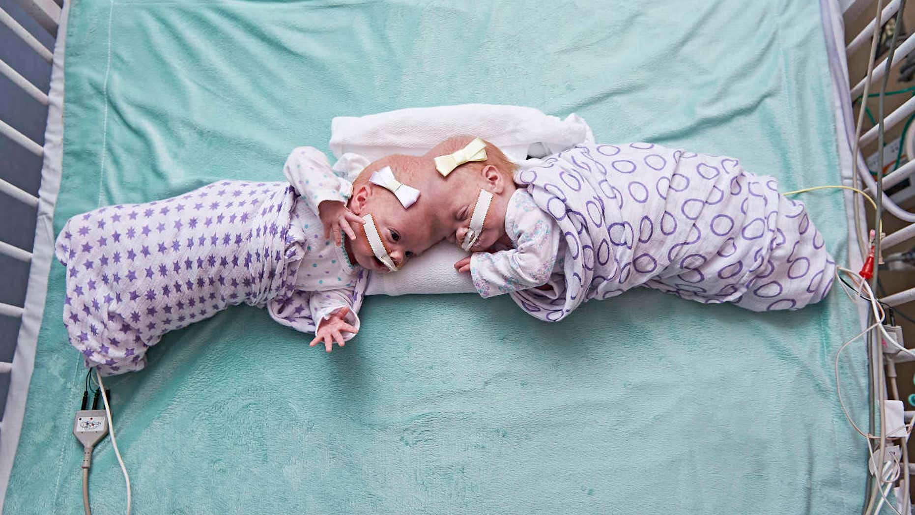 This September 2016 photo provided by the Children's Hospital of Philadelphia shows conjoined twin girls Abby Delaney, right, and Erin at the Children's Hospital of Philadelphia in Philadelphia.