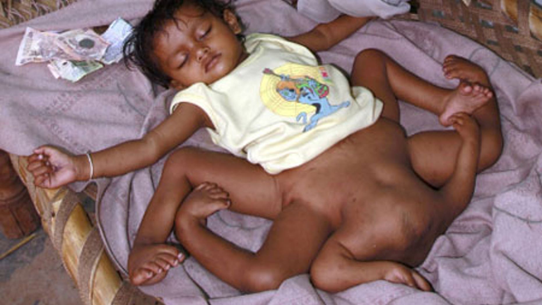8 limbed boy needs