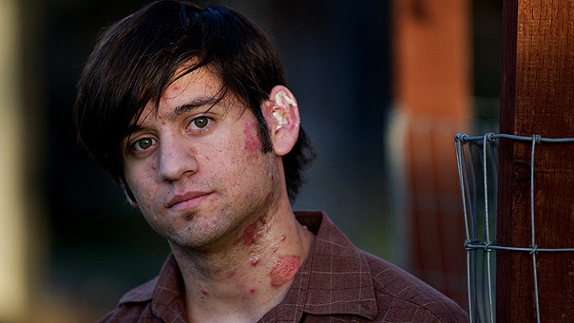 Dec. 8: Boston Market employee David Almas, 21, is seen in Elverta, Calif. Almas suffered second-degree burns when a hot creamed spinach dish was thrown into his face.