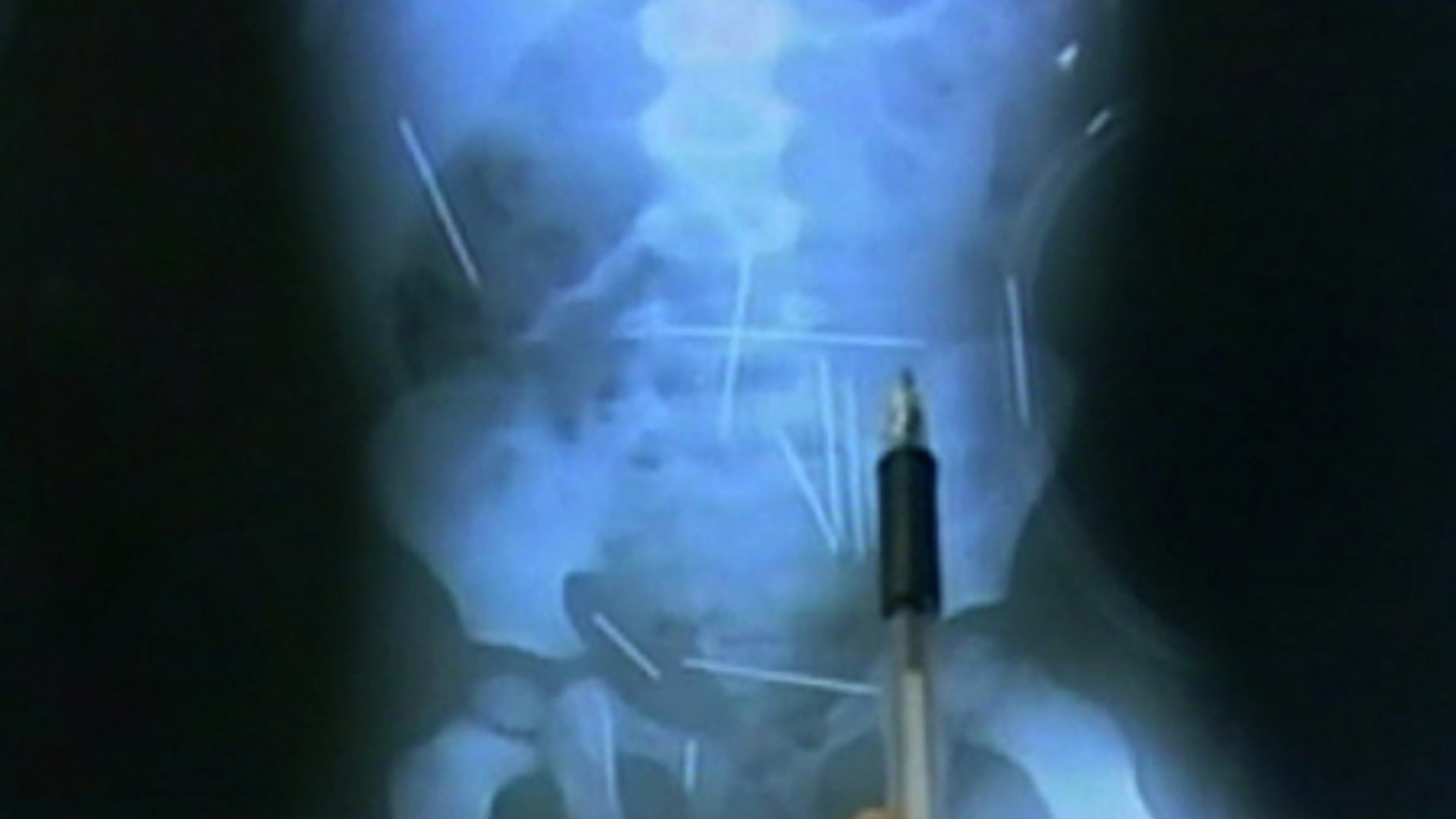 In this frame taken from a TV Globo video, a person points at a X-ray of a 2-year-old boy showing needles inside his body in a hospital in Ibotirama.
