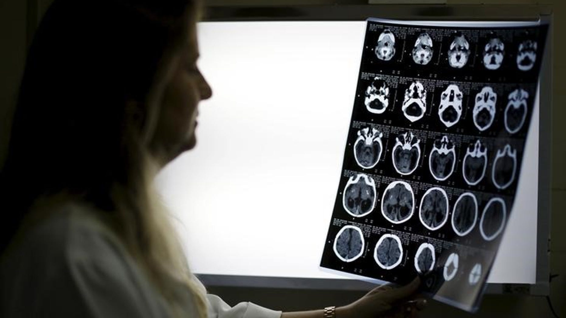 Child Neurologist Vanessa Van Der Linden observes the X-ray of a baby's skull with microcephaly at the hospital Barao de Lucena in Recife, Brazil
