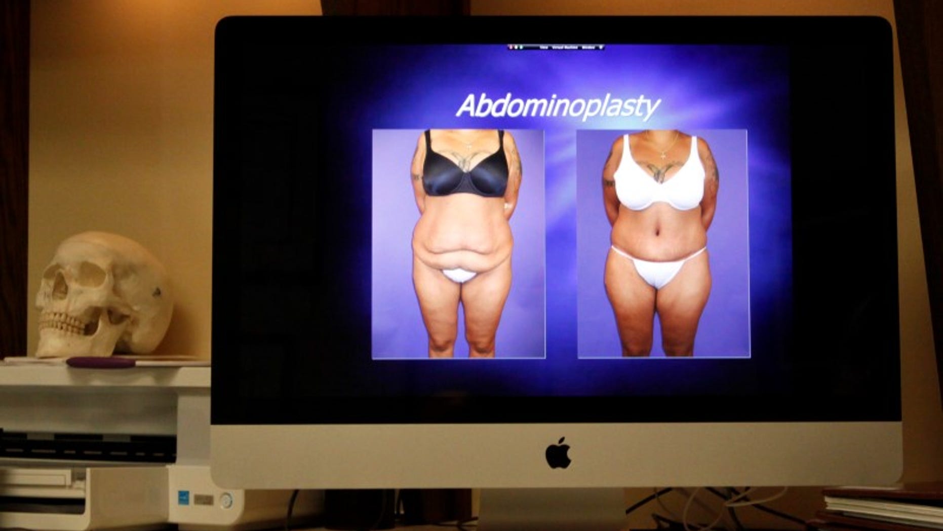 A computer screen shows before and after photos of an abdominoplasty patient after the patient had massive weight loss due to bariatric surgery