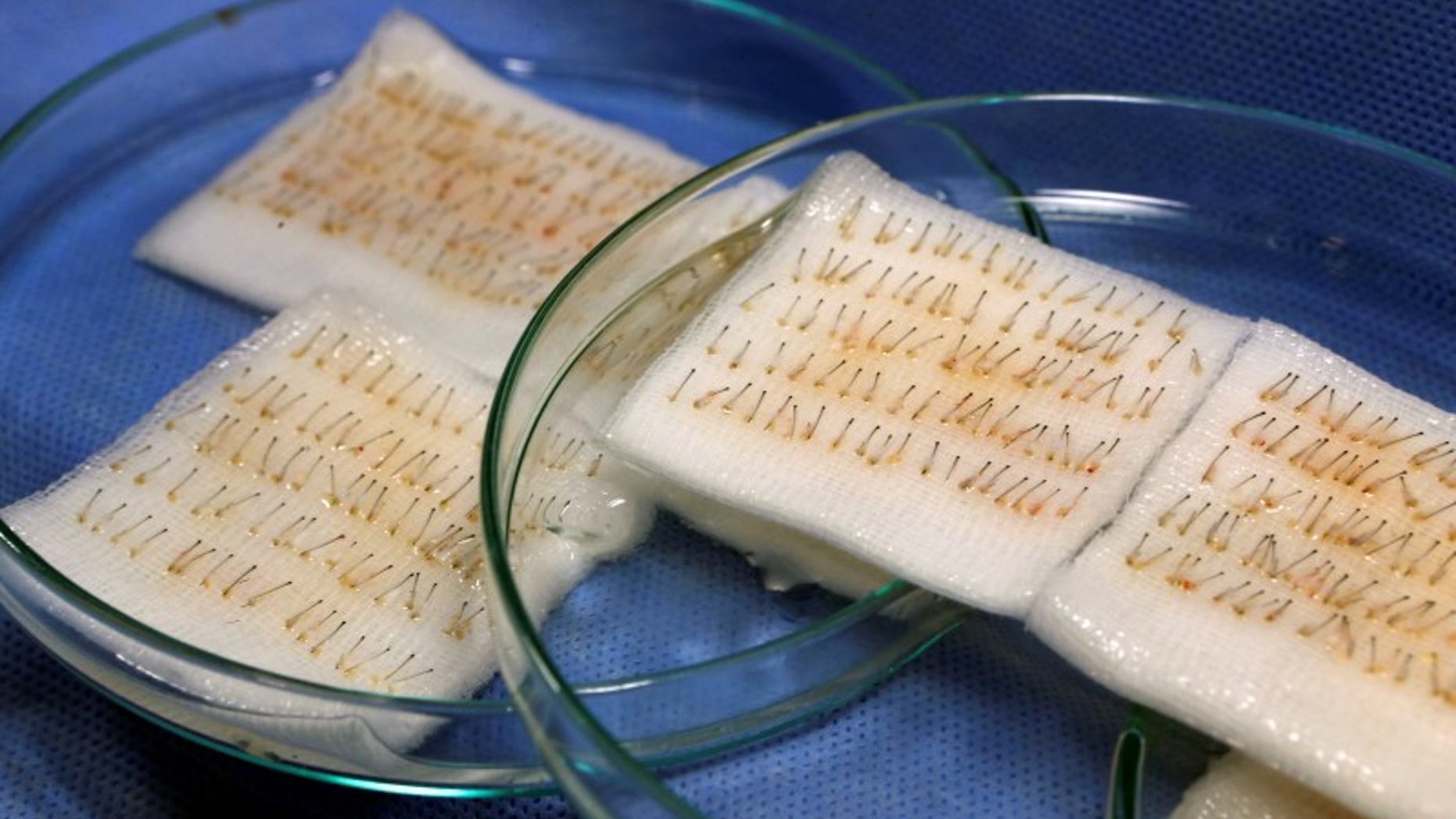 File photo of roots taken from a patient during a hair transplant operation at a clinic of Esteworld, an aesthetic private hospital group, in Istanbul