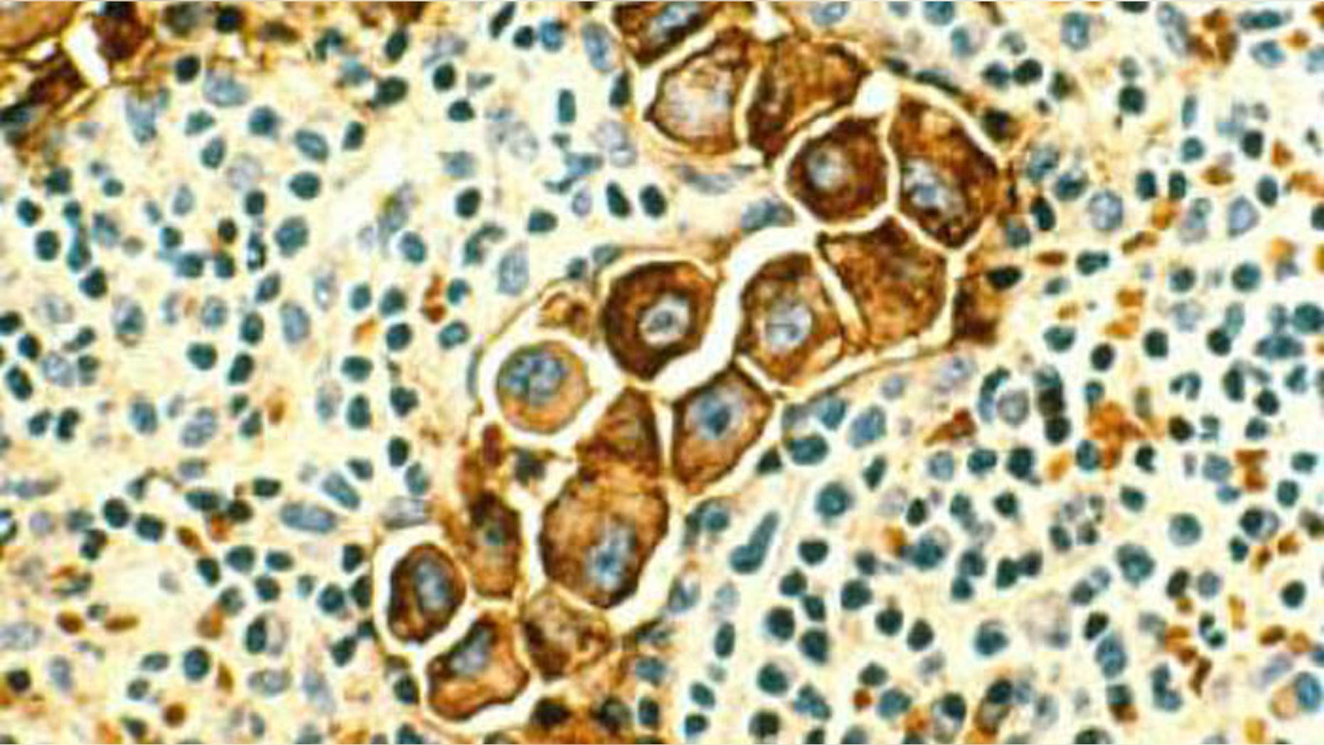 This image shows metastasized human breast cancer cells (magnified 400 times, stained brown) in lymph nodes.