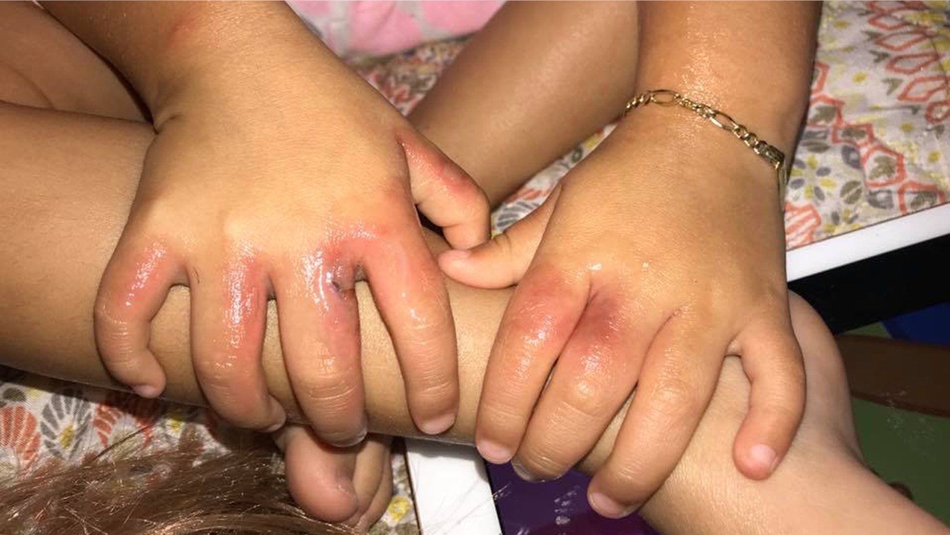 A toddler caught two bacterial infections after a birthday celebration at a Florida beach last weekend.