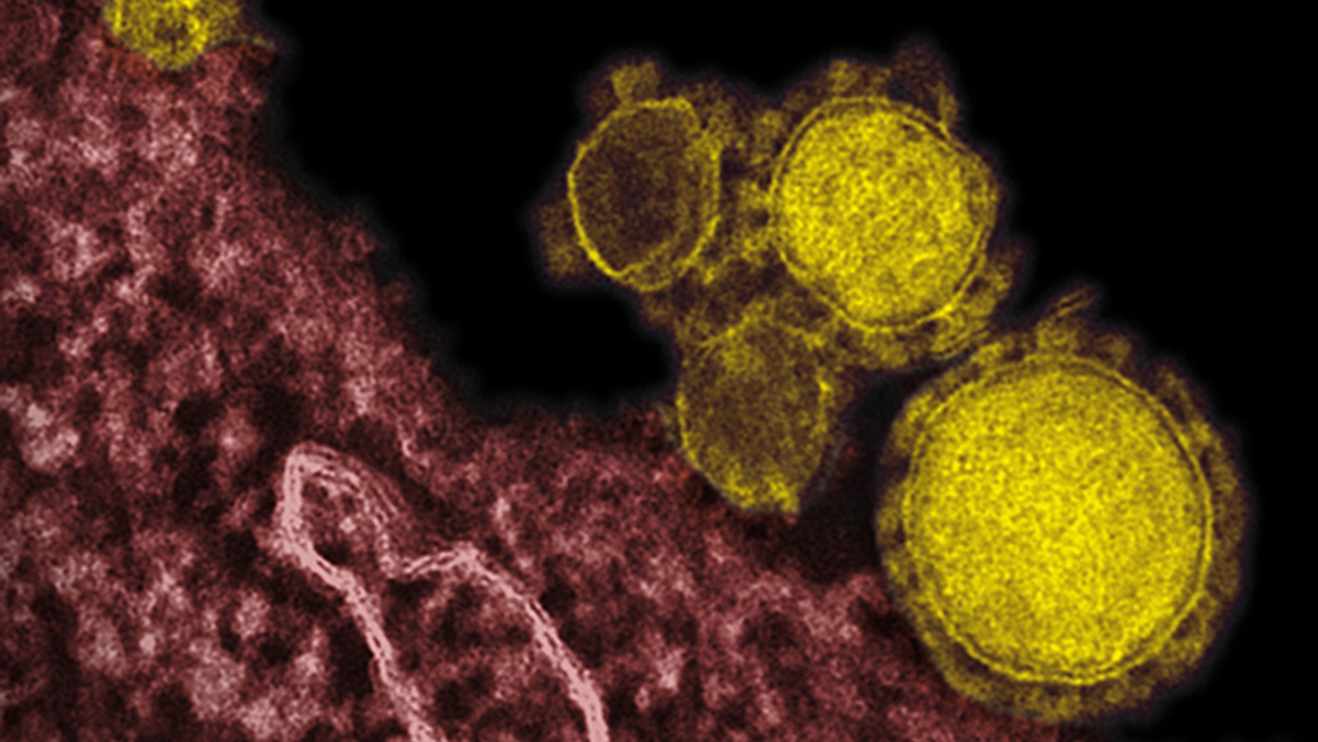 This electron microscope image shows the MERS virus, colorized in yellow. The mysterious new respiratory virus that originated in the Middle East spreads easily between people and appears more deadly than SARS, doctors reported.