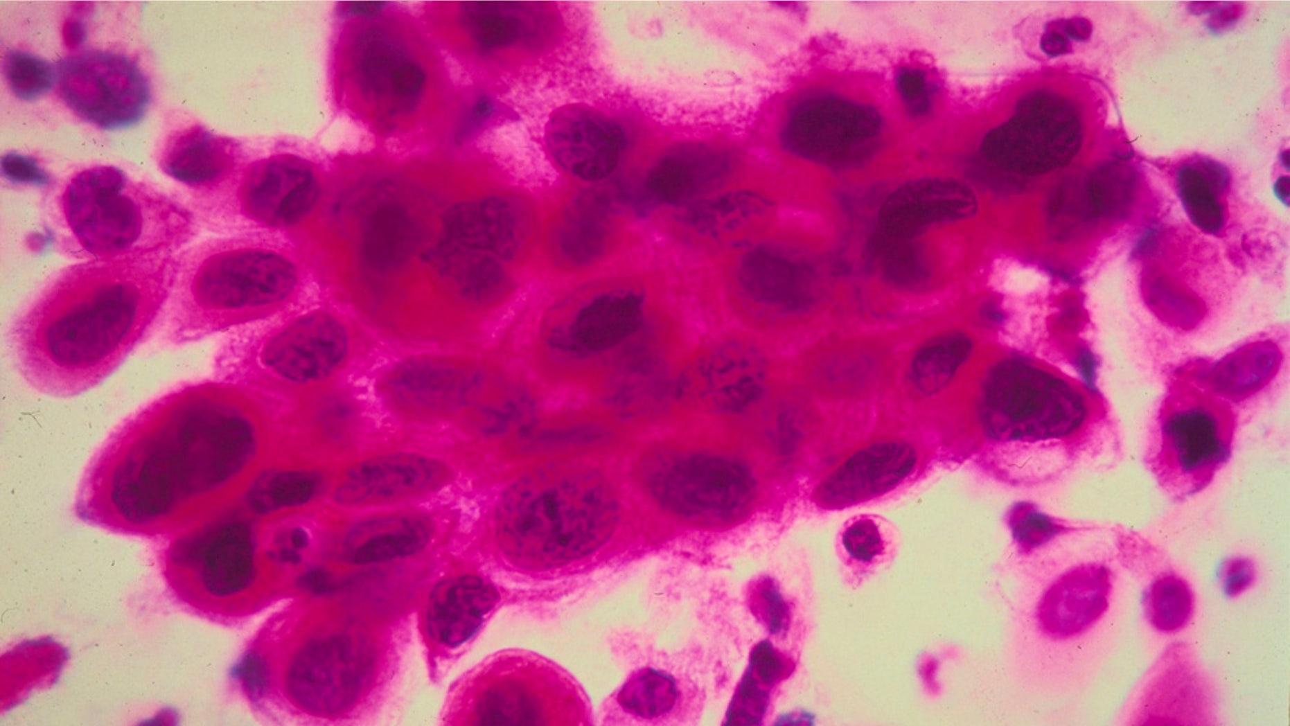 Close up of cancer cells in the cervix. Cancer of the uterine cervix, the portion of the uterus that is attached to the top of the vagina. (Photo by American Cancer Society/Getty Images)