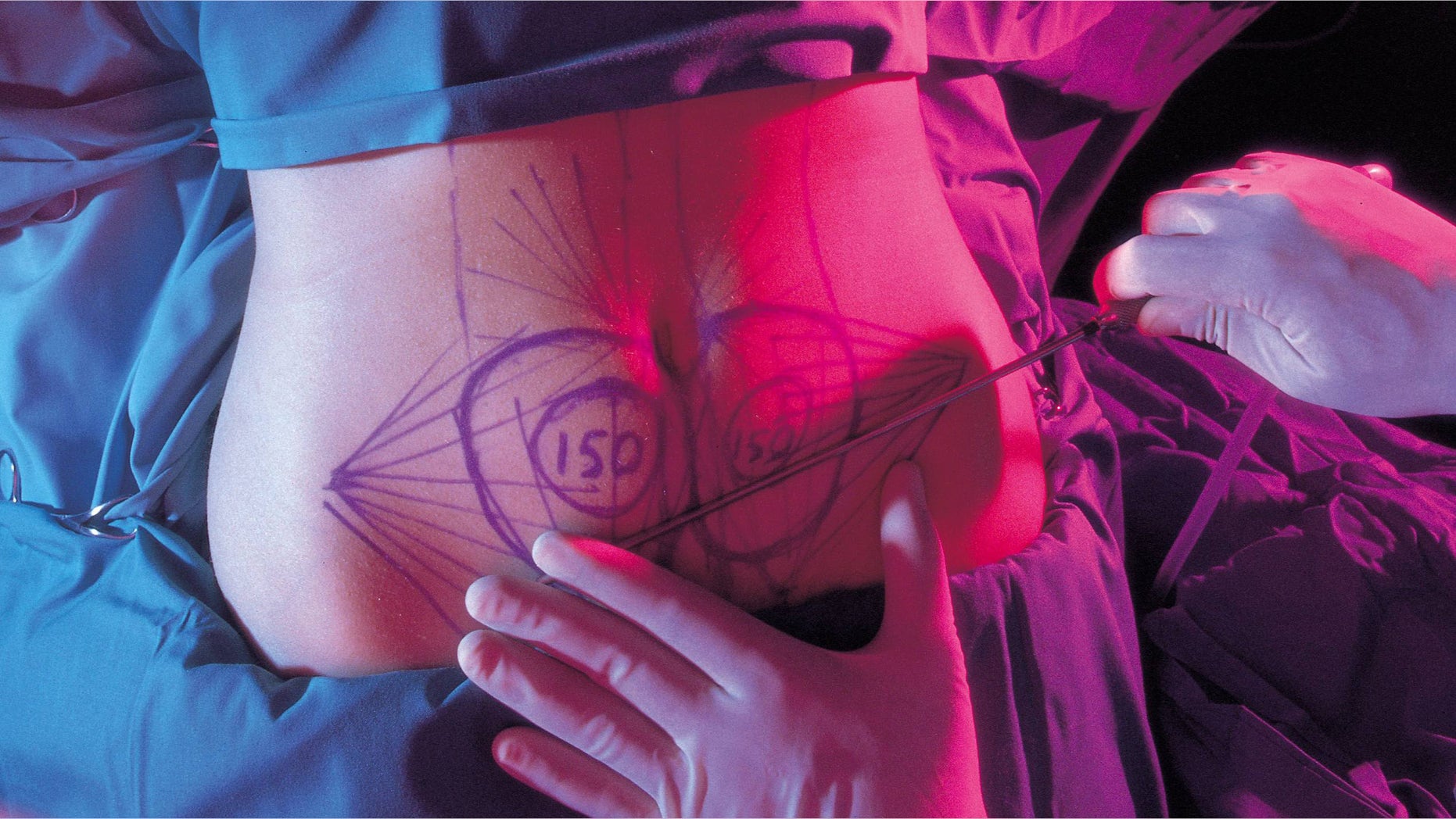 Liposuction Detail of the drawn stomach of an awake woman in the liposuction operation (Photo by Luis Davilla/Cover/Getty Images)
