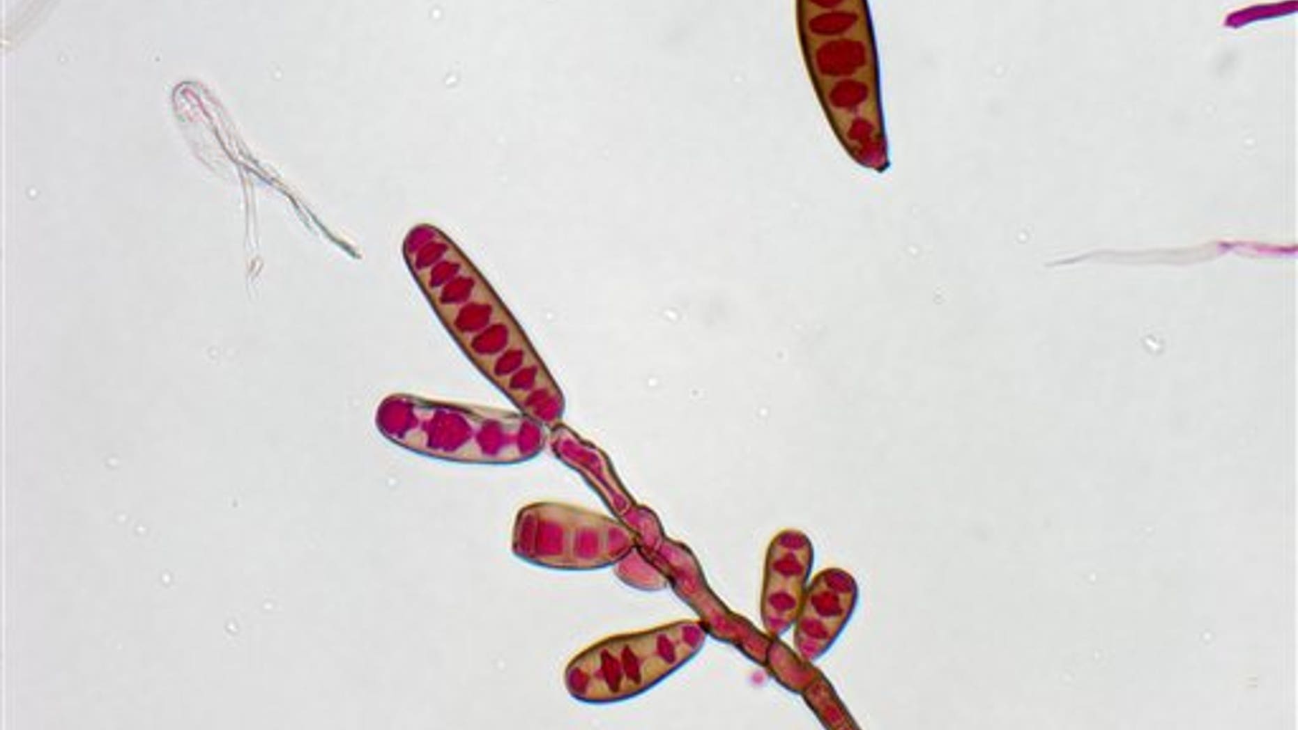 FILE - This undated file image made available by The Centers for Disease Control and Prevention shows the Exserohilum rostratum fungus. The black mold creeping into the spines of hundreds of people who got tainted shots for back pain marks uncharted medical territory. Doctors are beginning to detail in medical journals the first deaths in this outbreak, and the grim autopsy findings make clear that treating early is crucial, before the fungus becomes entrenched. (AP Photo/The Centers for Disease Control, File)