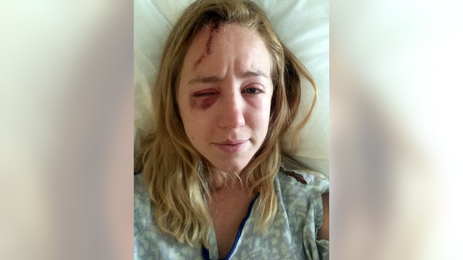 In this photo taken on June 19, 2015 provided by Mollyann Hart, Hart poses for a selfie showing injuries from a lightning strike while recovering at a hospital in Hagerstown, Md. She and her sister were struck after taking shelter inside a stone observation tower at Washington Monument State Park. The tower reopened Thursday, April 28, 2016, after a closure to repair damage caused by the strike. (Mollyann Hart via AP)