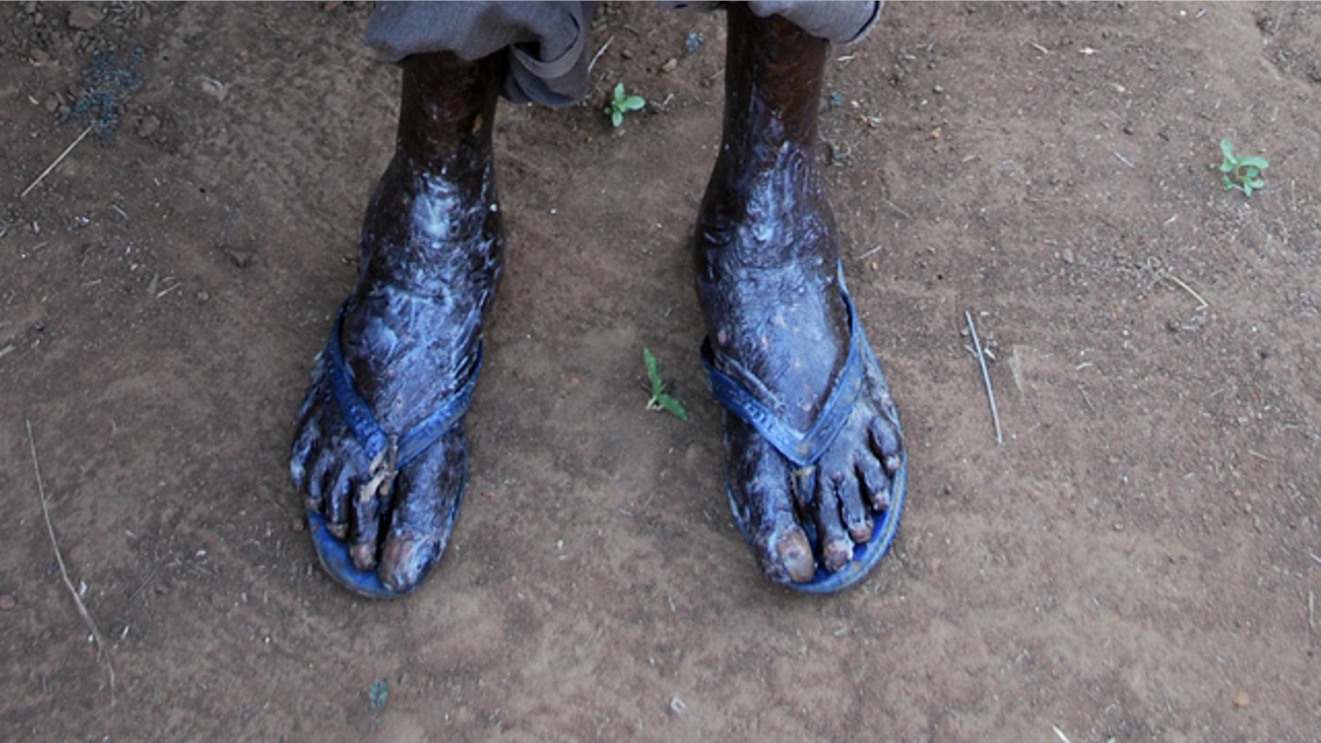 Oct. 13: A resident of Kamuli district in eastern Uganda displays his feet infested by jiggers.