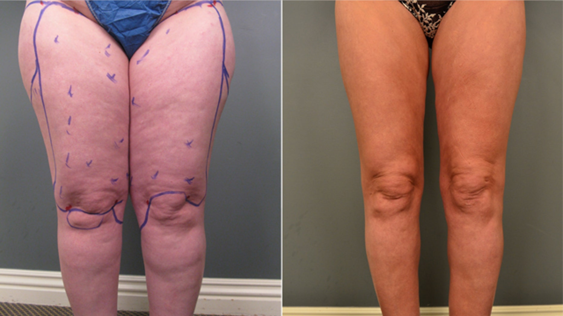 Jasna Turnic’s legs before (left) and after (right) getting liposuction to treat her lipedema.