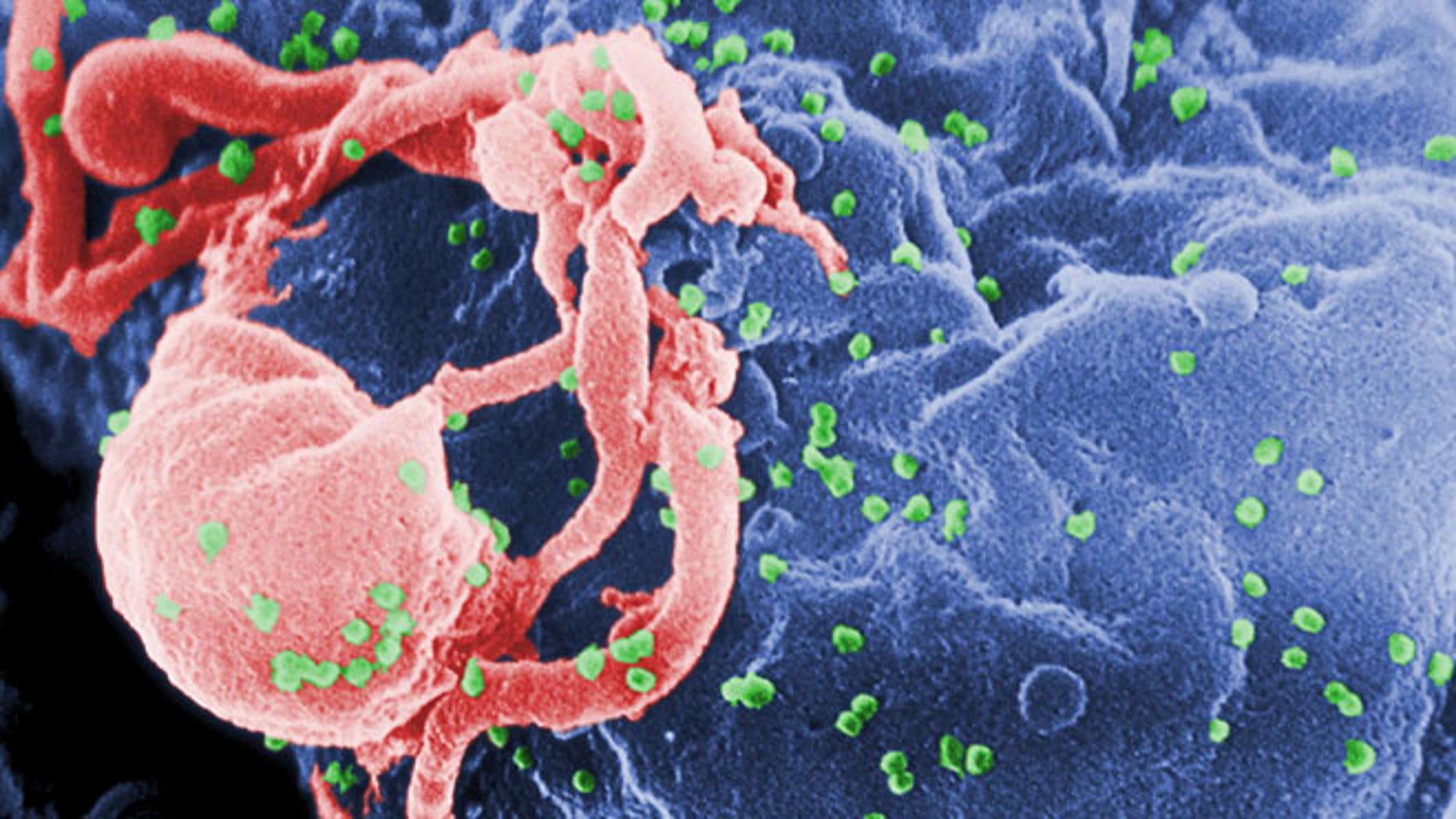 case study on hiv virus