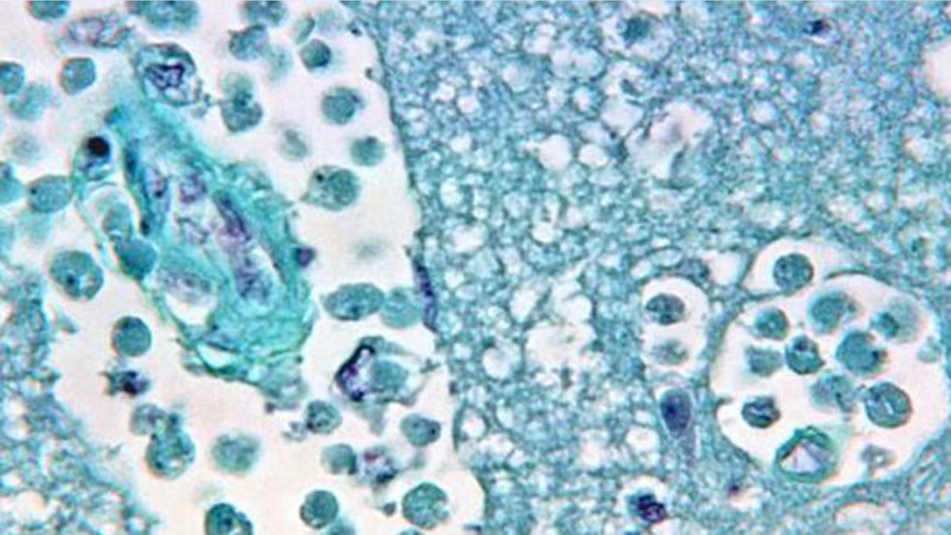 Naegleria fowleri, also referred to as the "brain-eating amoeba" or "brain-eating ameba," thrives in freshwater at warm temperatures. It can cause a rare but deadly infection of the brain called primary amebic meningoencephalitis (PAM).