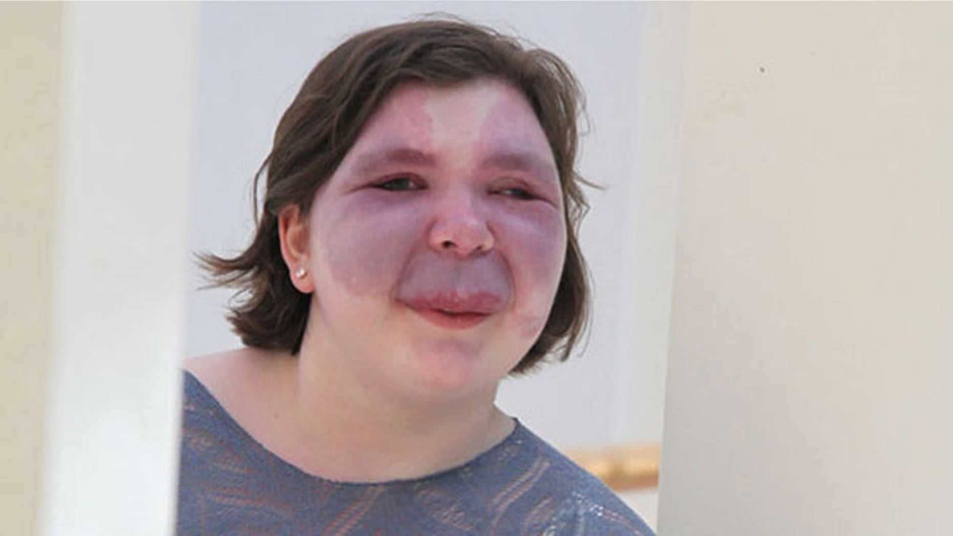 Photo of a woman with Sturge-Weber Syndrome. One of the classic symptoms of the condition is a port-wine stain that typically appears on the face. Credit: Sturge-Weber Foundation