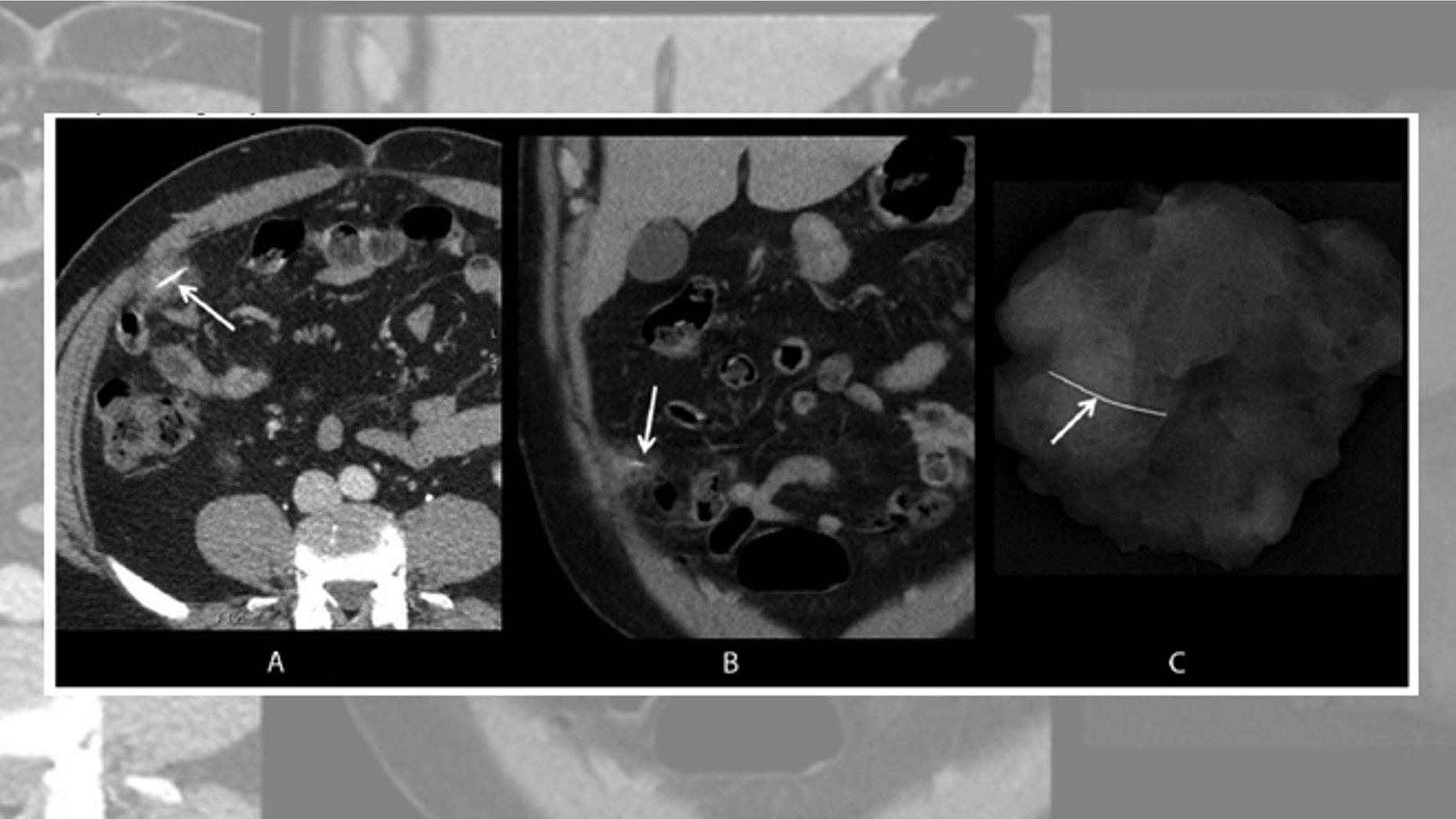 Axial and coronal images (A, B) from intravenous contrast-enhanced computed tomography show a wire grill-cleaning brush bristle in the omentum (arrows), surrounded by soft tissue stranding (inflammation); a specimen radiograph (C) from omental resection confirms complete foreign object retrieval (arrow).