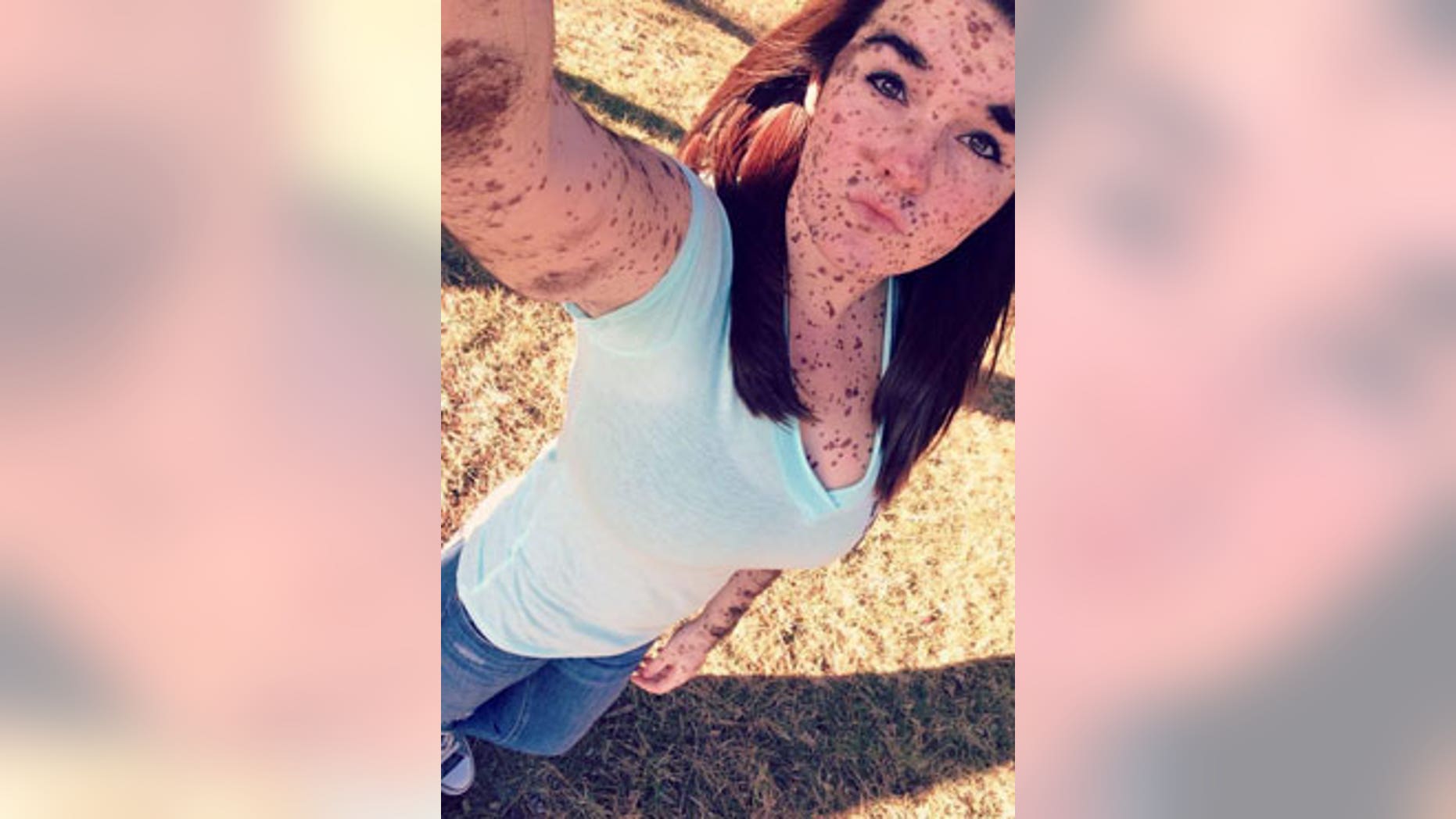 19yearold born with body covered in birthmarks is ‘proud to be