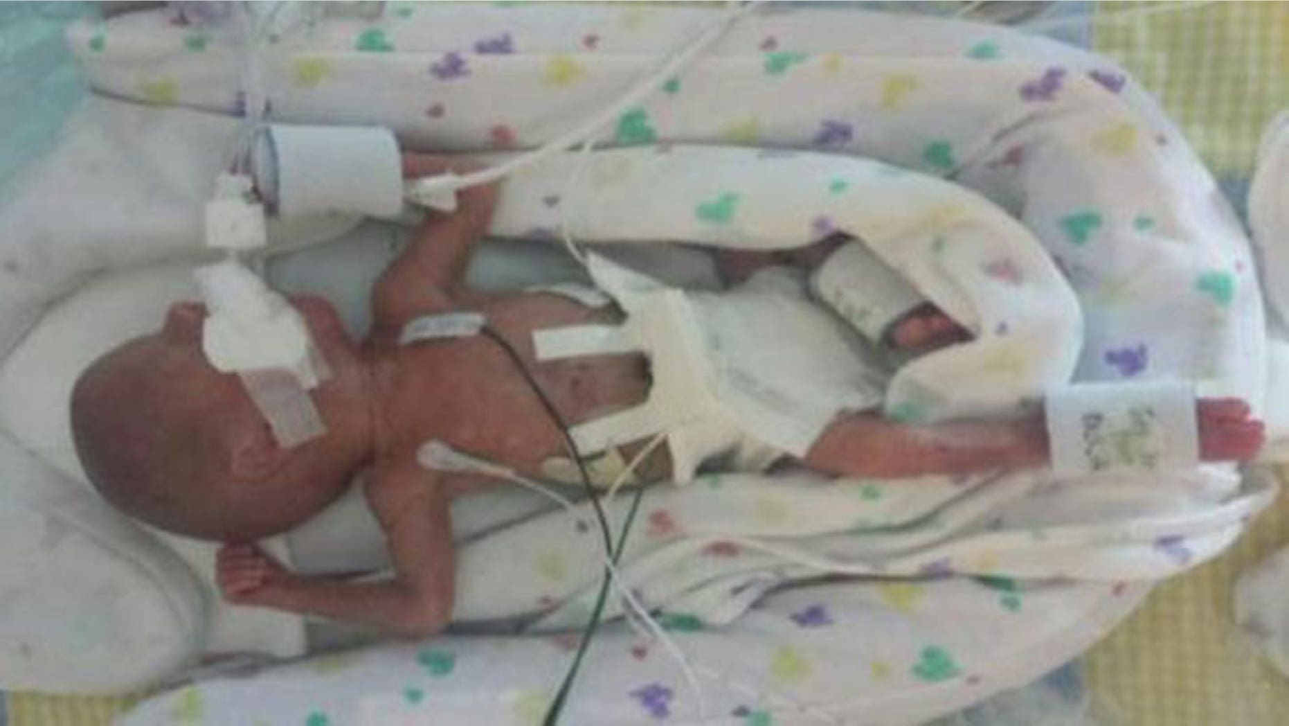 Link Gorveatt, pictured here, was born extremely premature at 23 weeks old on Tuesday, Sept. 29. He and his twin brother, Logan, suffered from twin-to-twin transfusion syndrome, a condition marked by a shared placenta in utero.