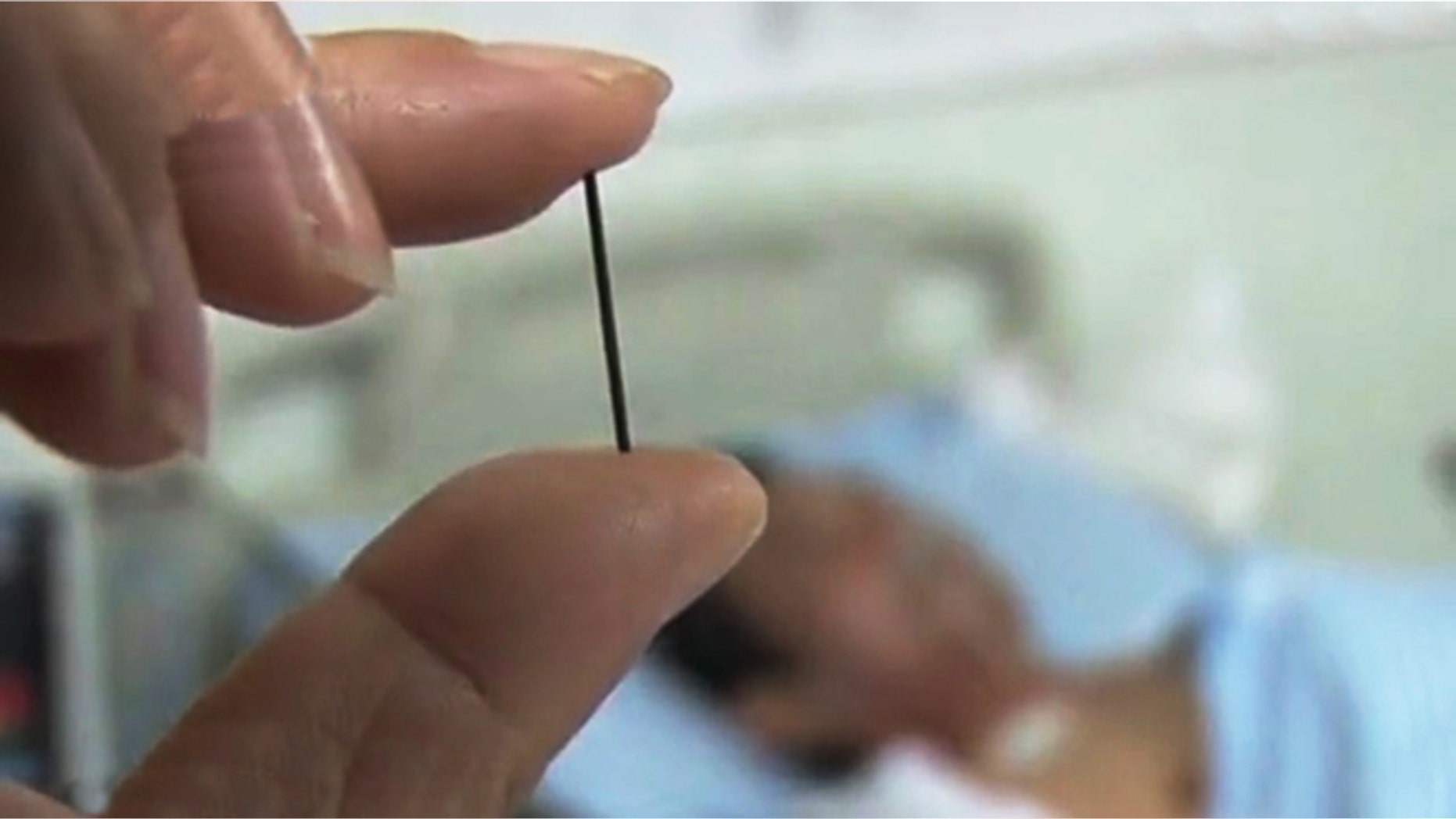 Doctors hold up an acupuncture needle that had been lodged in 60-year-old Xu Long's gut for 40 years. Central European News (CEN)