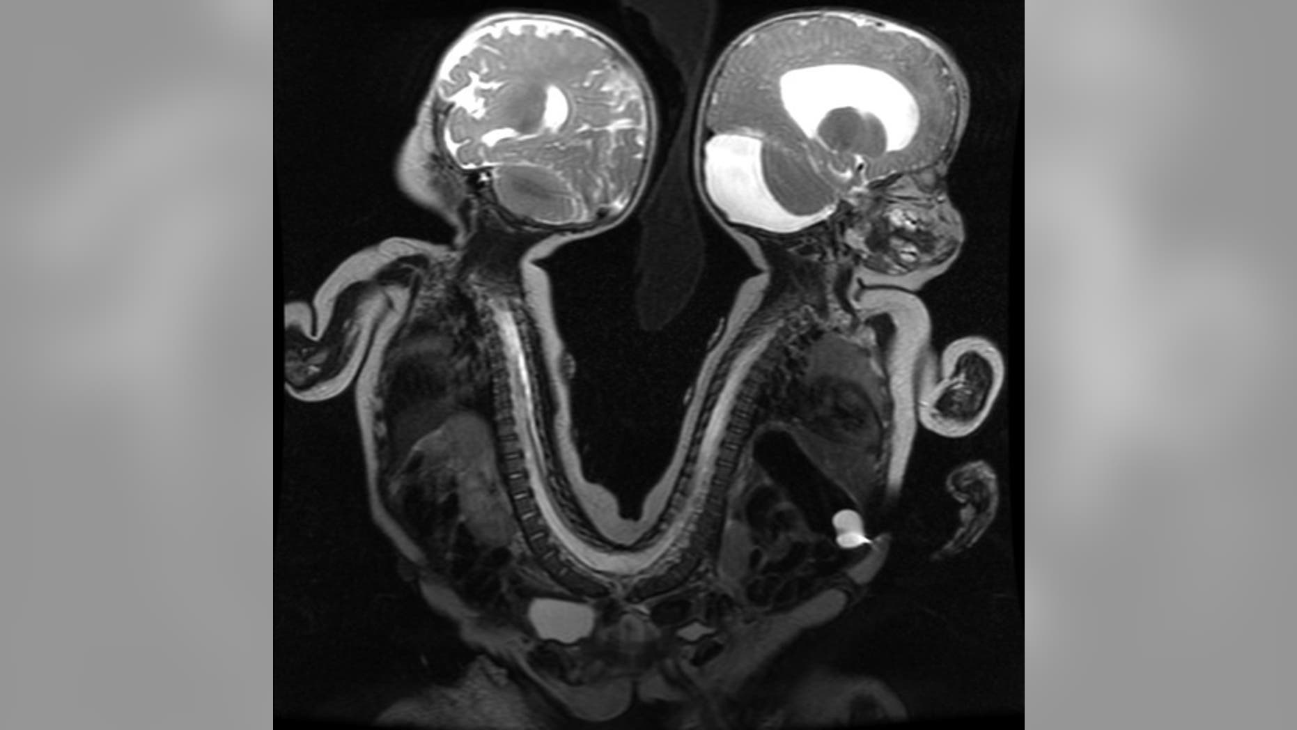 The conjoined twins in a MRI image before they were separated.