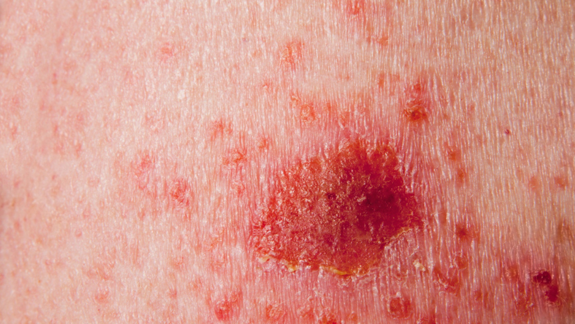 pictures of skin cancers